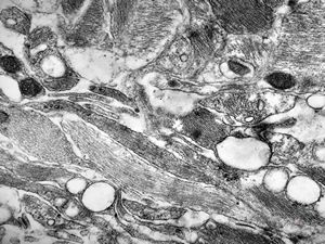 M,26y. | periphery of a glial scar